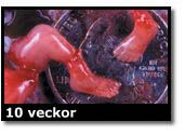 Abortbild - 10 veckor