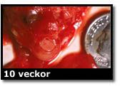 Abortbild - 10 veckor