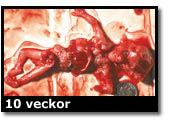 Abortbild - 10 veckor