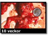 Abortbild - 10 veckor