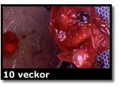 Abortbild - 11 veckor