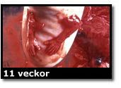 Abortbild - 11 veckor