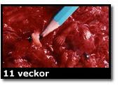 Abortbild - 11 veckor