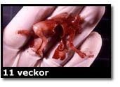 Abortbild - 11 veckor