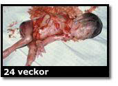 Abortbild - 22 veckor