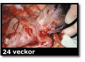 Abortbild - 22 veckor