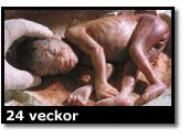 Abortbild - 24 veckor